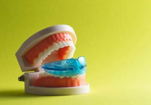 Mouth with teeth nightguard.