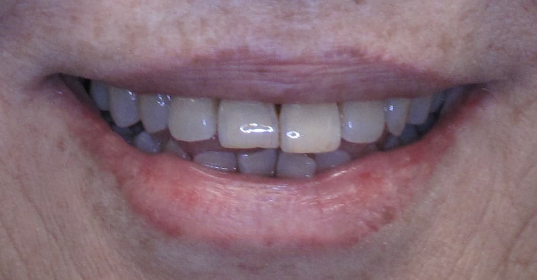 Denture Implants before