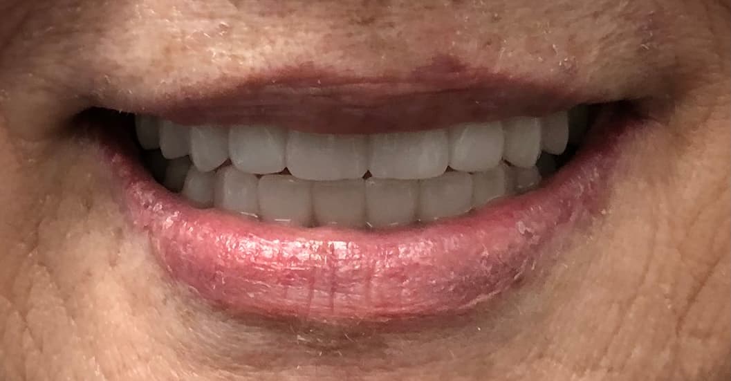 Denture Implants after