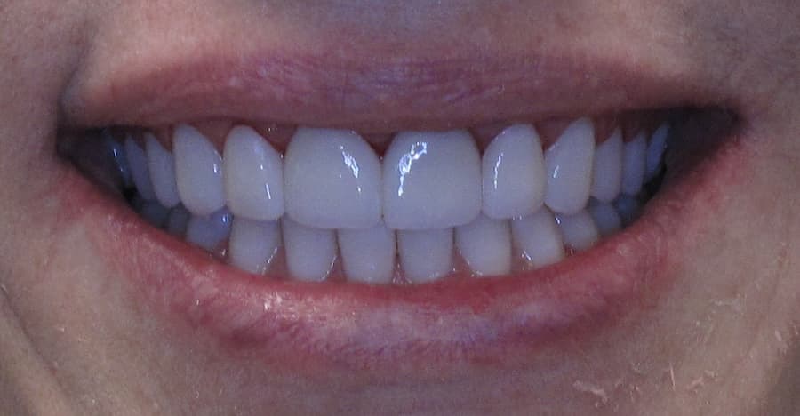 Crowns after