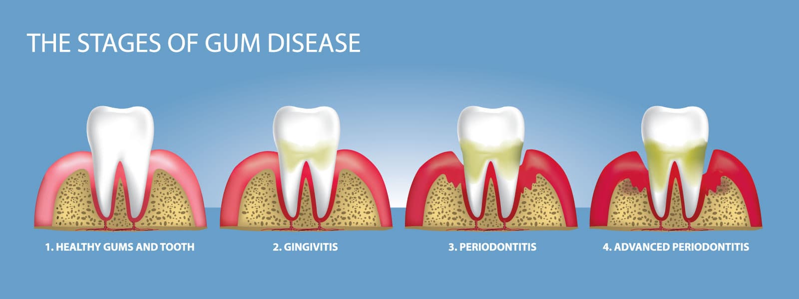 Stages of gum disease