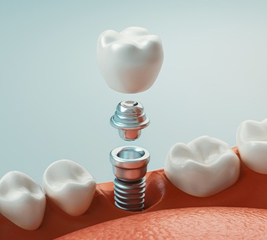 A 3D rendering of a whole dental implant and its parts