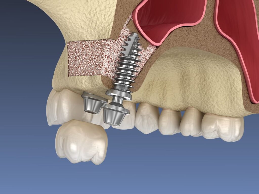 A computer-generated image of a jawbone with a sinus lift and dental implant